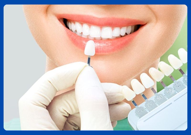 How long Do Dental Veneers Last and How to Care for Them