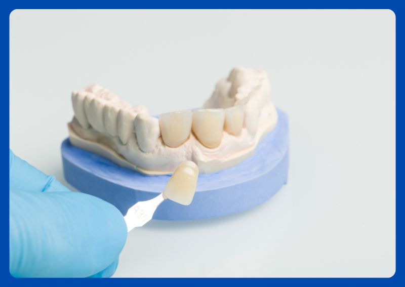 Dental veneers preparation and aftercare guide at Dr. Han Dental Lounge