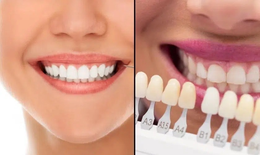 Veneers vs Teeth Whitening for a perfect smile