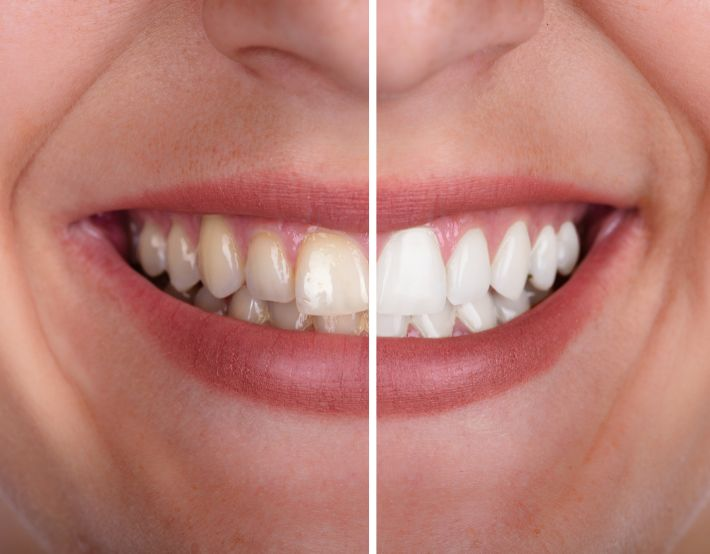 Dental Veneers in Dubai - Porcelain, Emax, Composite, Ceramic, and Celebrity Veneers