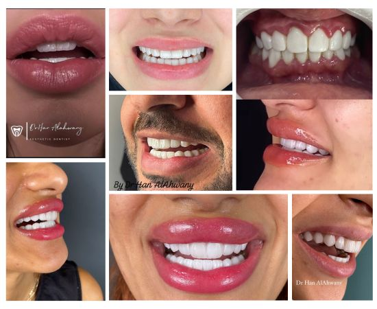 Emax Veneers in Dubai - Porcelain and Composite Veneers