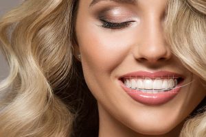Celebrity veneers giving a Hollywood smile with bright, flawless teeth