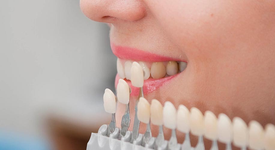 Dental veneers myths and facts for a perfect smile