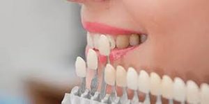 Dental veneers treatment near Jumeirah 1, 2 and 3 Dubai by Dr. Han AlAhwany