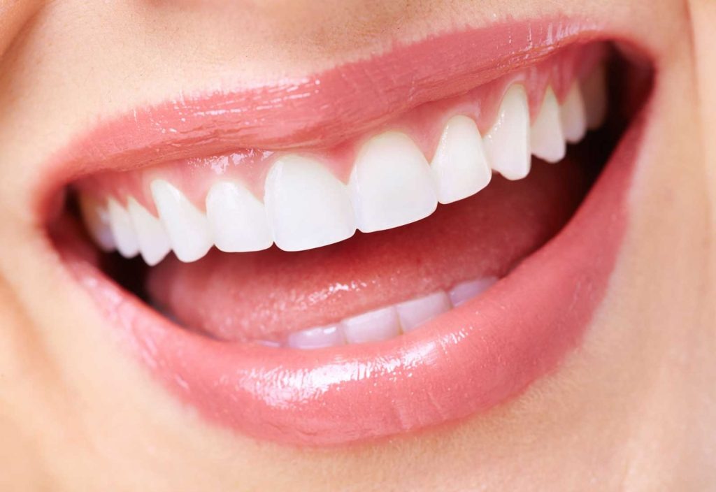 Veneers Before and After Complete Smile Transformation