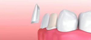 No-Prep Veneers Dubai - Shaveless, Non-Invasive Smile Makeover at Dr. Han Alahwany Clinic